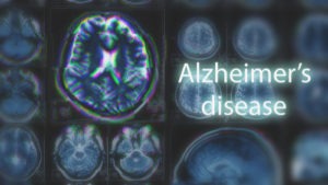 Alzheimer's Disease Compensation
